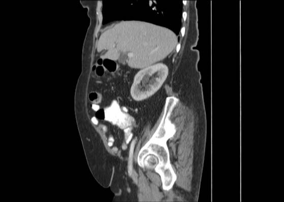 Bicameral celiacomesenteric aneurysm (Radiopaedia 55766-62327 B 19).jpg