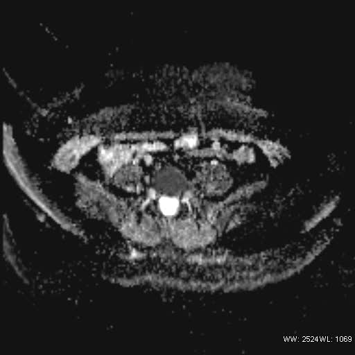 File:Bicornuate uterus- on MRI (Radiopaedia 49206-54297 Axial ADC 4).jpg