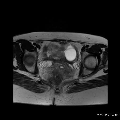 File:Bicornuate uterus- on MRI (Radiopaedia 49206-54297 Axial T2 11).jpg