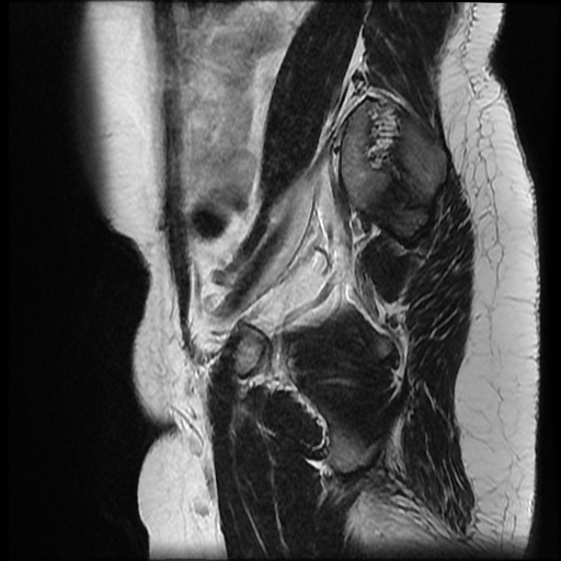 File:Bicornuate uterus (Radiopaedia 51676-57472 Sagittal T2 6).jpg