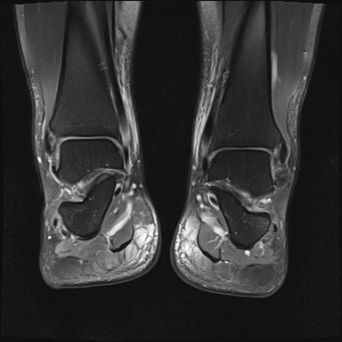 File:Bilateral Achilles tendon complete tear (Radiopaedia 81344-95051 Coronal PD fat sat 10).jpg