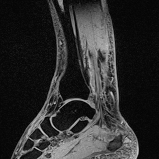 Bilateral Achilles tendon complete tear (Radiopaedia 81344-95051 Sagittal WE - Right 70).jpg