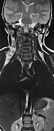 File:Bilateral Sprengel deformity with Klippel-Feil syndrome (Radiopaedia 66395-75650 F 3).jpg
