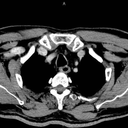 Bilateral Warthin tumors (Radiopaedia 84034-99263 Axial With contrast 67).jpg