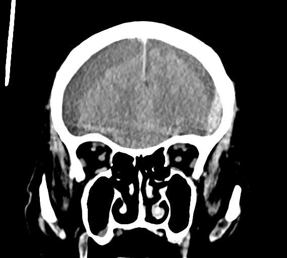 Bilateral acute on chronic subdural hematomas (Radiopaedia 78466-91146 Coronal non-contrast 20).jpg