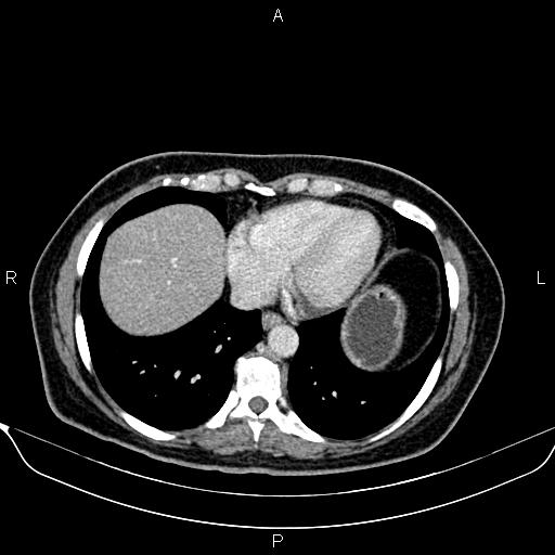 Bilateral benign adrenal adenomas (Radiopaedia 86912-103124 B 12).jpg
