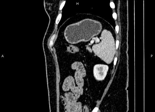 Bilateral benign adrenal adenomas (Radiopaedia 86912-103124 E 84).jpg