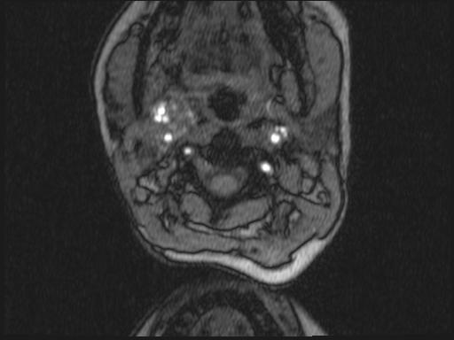Bilateral carotid body tumors and right glomus jugulare tumor (Radiopaedia 20024-20060 Axial MRA 271).jpg