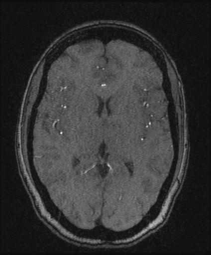 Bilateral carotid body tumors and right glomus jugulare tumor (Radiopaedia 20024-20060 Axial MRA 99).jpg