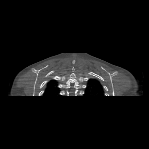 File:Bilateral chronic posterior shoulder dislocation (Radiopaedia 39213-41452 Coronal bone window 53).jpg