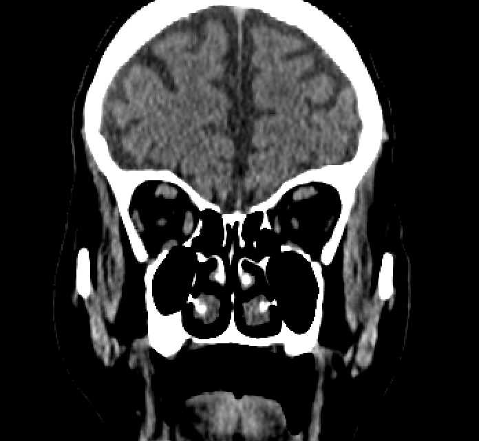 Bilateral ectopia lentis (Radiopaedia 89889-107013 Coronal non-contrast 70).jpg