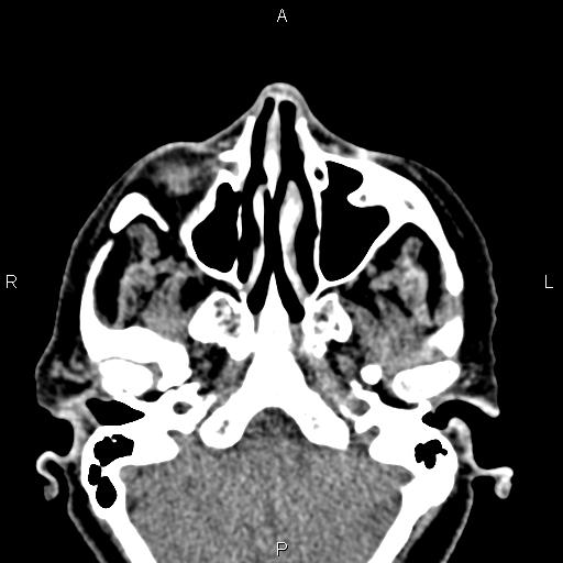 Bilateral enlargement of lacrimal glands - sarcoidosis (Radiopaedia 62627-70921 Axial non-contrast 21).jpg