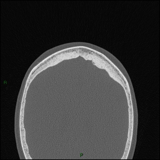 Bilateral frontal mucoceles (Radiopaedia 82352-96454 Axial bone window 20).jpg