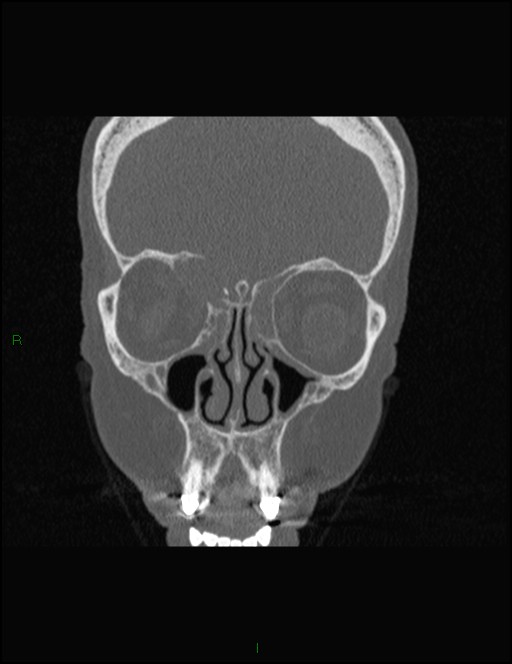 Bilateral frontal mucoceles (Radiopaedia 82352-96454 Coronal 116).jpg