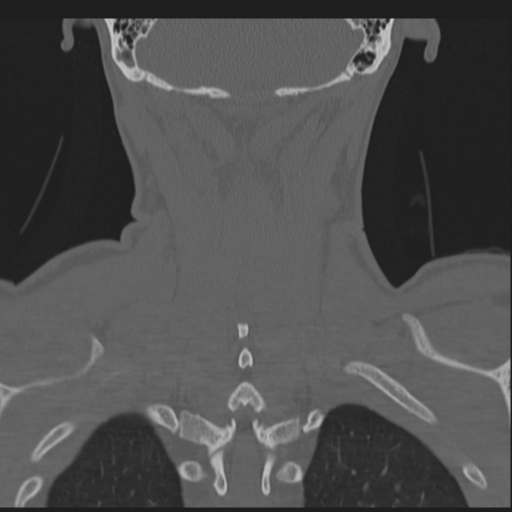 File:Bilateral locked facets (Radiopaedia 33850-35016 Coronal bone window 70).png