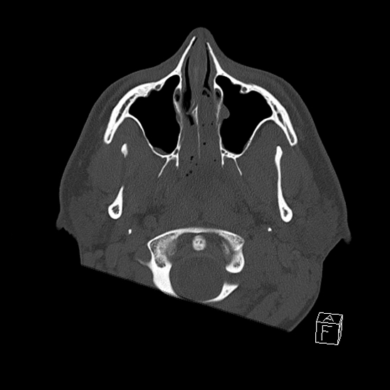 Bilateral occipital condyle fracture (type 2) (Radiopaedia 87675-104089 Axial bone window 2).jpg