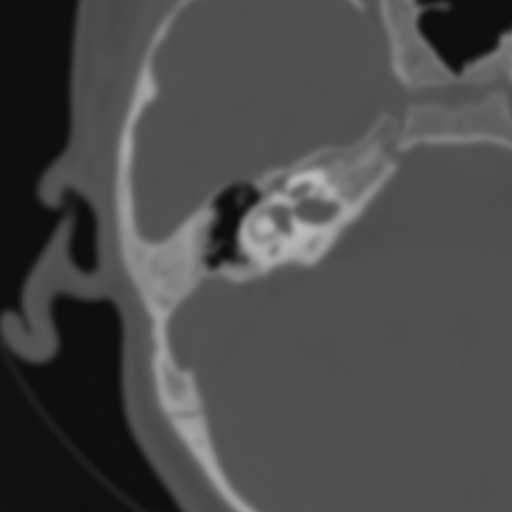 Bilateral otosclerosis (Radiopaedia 57237-64157 B 63).jpg