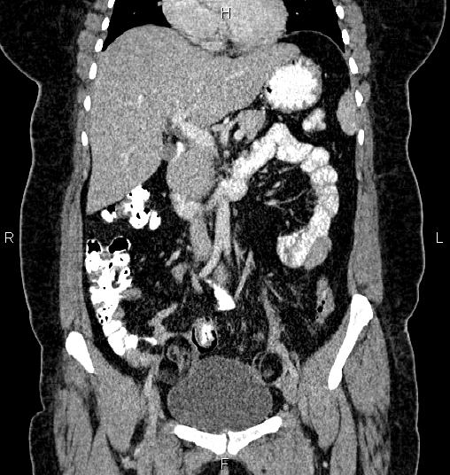 Bilateral ovarian dermoid cysts (Radiopaedia 85785-101603 C 21).jpg