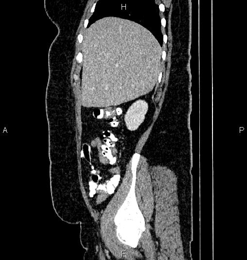 Bilateral ovarian dermoid cysts (Radiopaedia 85785-101603 D 15).jpg