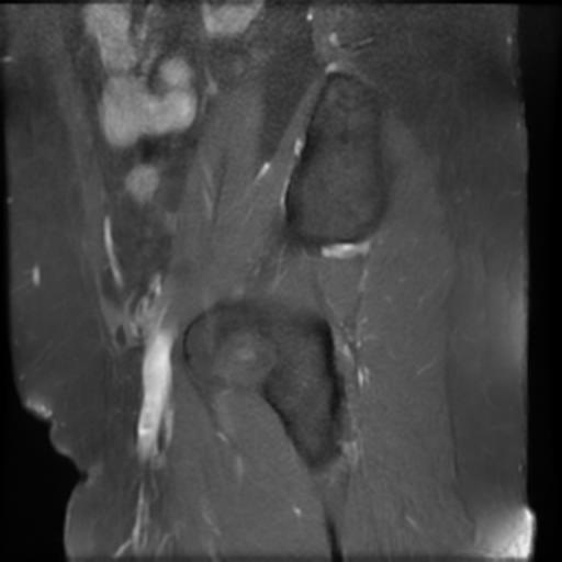 File:Bilateral ovarian dermoid cysts (Radiopaedia 90152-107338 Sagittal T1 C+ 23).jpg