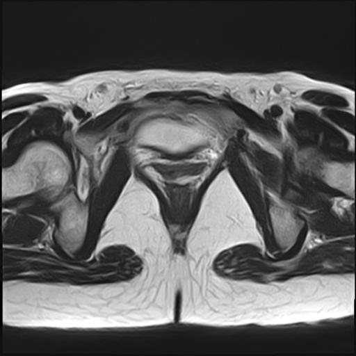 File:Bilateral ovarian endometriomas (Radiopaedia 87085-103347 Axial T2 19).jpg