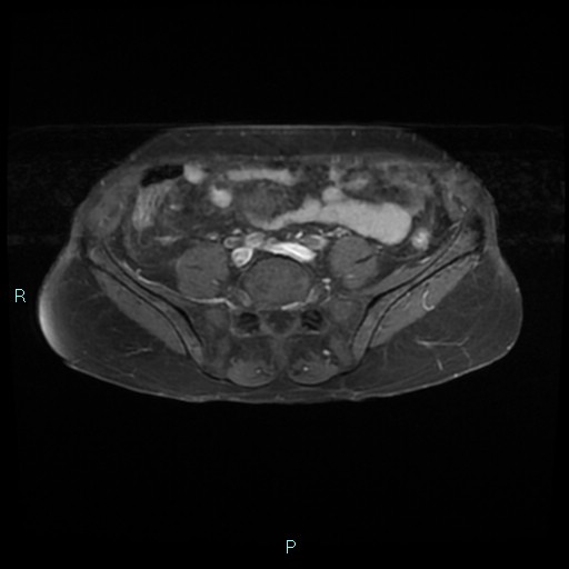 File:Bilateral ovarian fibroma (Radiopaedia 44568-48293 Axial T1 C+ fat sat 2).jpg