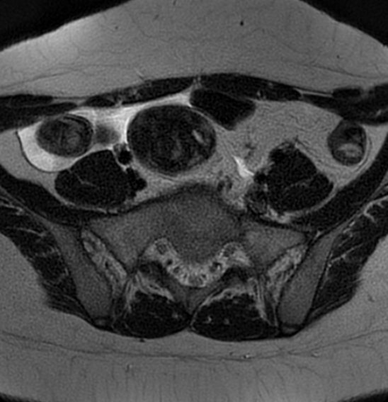 File:Bilateral ovarian fibrothecomas - adolescent (Radiopaedia 86604-102707 Axial T2 8).jpg