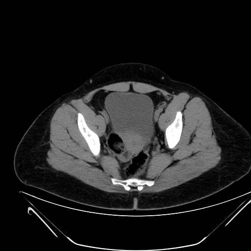 Bilateral ovarian mature cystic teratomas (Radiopaedia 79373-92457 Axial non-contrast 67).jpg