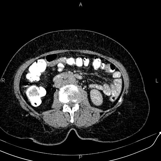 Bilateral ovarian serous cystadenocarcinoma (Radiopaedia 86062-101989 Axial C+ delayed 30).jpg