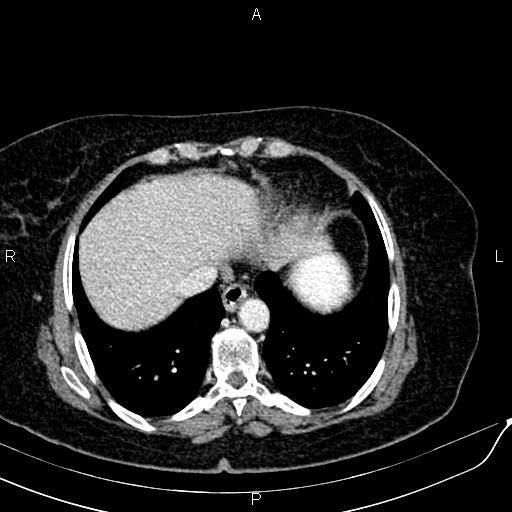 Bilateral ovarian serous cystadenocarcinoma (Radiopaedia 86062-101989 B 13).jpg