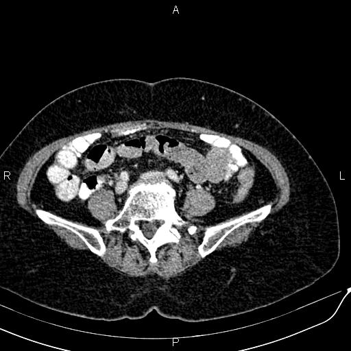 Bilateral ovarian serous cystadenocarcinoma (Radiopaedia 86062-101989 B 68).jpg