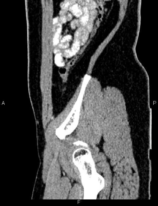 Bilateral ovarian teratoma (Radiopaedia 83131-97503 D 94).jpg