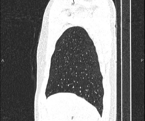 Bilateral pulmonary AVM (Radiopaedia 83134-97505 Sagittal lung window 26).jpg