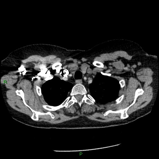 Bilateral pulmonary emboli (Radiopaedia 32700-33669 Axial C+ CTPA 11).jpg