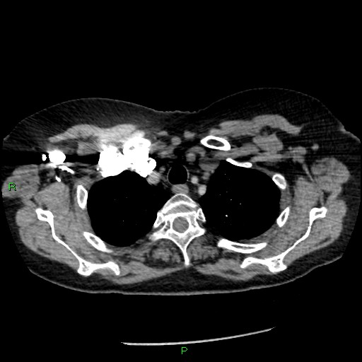 Bilateral pulmonary emboli (Radiopaedia 32700-33669 Axial C+ CTPA 14).jpg