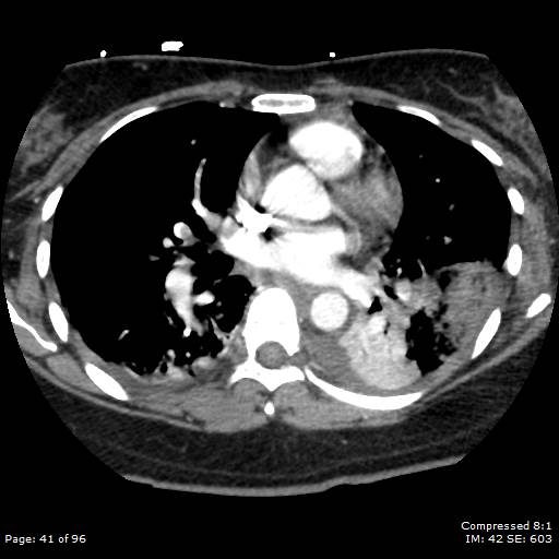Bilateral pulmonary emboli with Hampton hump sign (Radiopaedia 54070-60246 Axial C+ CTPA 38).jpg