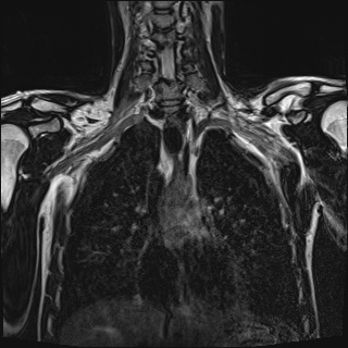 File:Bilateral spinoglenoid notch ganglion cysts (Radiopaedia 29577-30082 Coronal T2 53).jpg