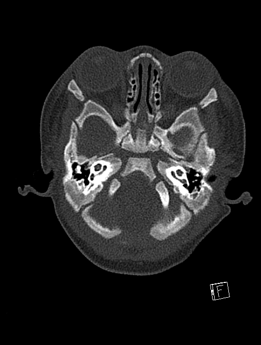 Bilateral subdural hemorrhage and parietal skull fracture (Radiopaedia 26058-26192 Axial bone window 110).png