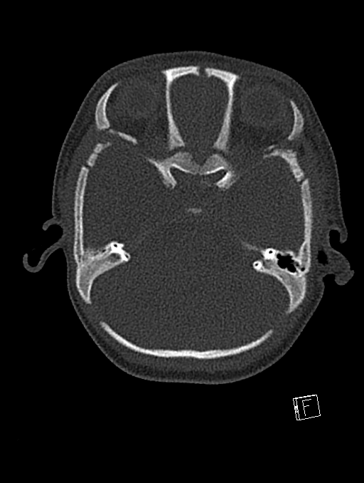Bilateral subdural hemorrhage and parietal skull fracture (Radiopaedia 26058-26192 Axial bone window 99).png