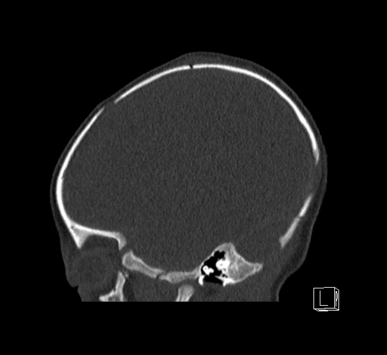 Bilateral subdural hemorrhage and parietal skull fracture (Radiopaedia 26058-26192 Sagittal bone window 76).png