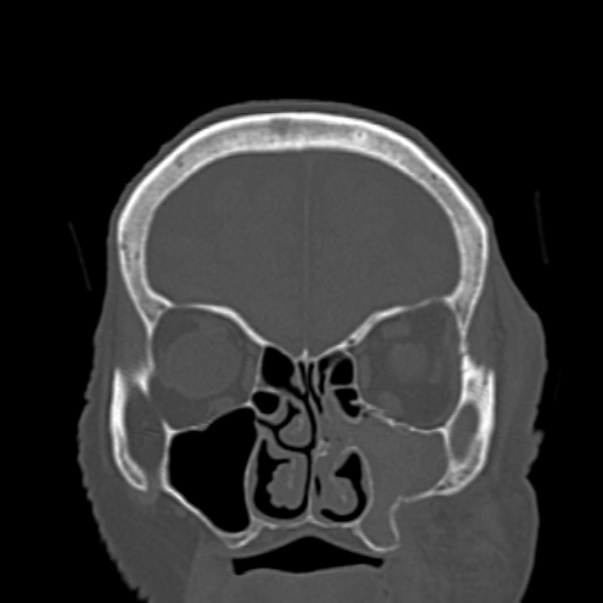Biparietal osteodystrophy (Radiopaedia 46109-50463 Coronal bone window 28).jpg
