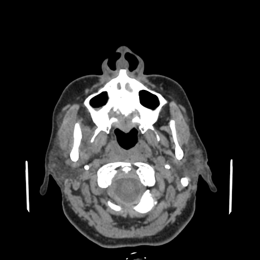 Bisphosphonate-related osteonecrosis of the jaw (Radiopaedia 71324-81642 non-contrast 121).jpg