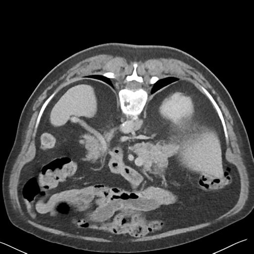 File:Bladder papillary urothelial carcinoma (Radiopaedia 48119-52951 Axial C+ delayed 12).png