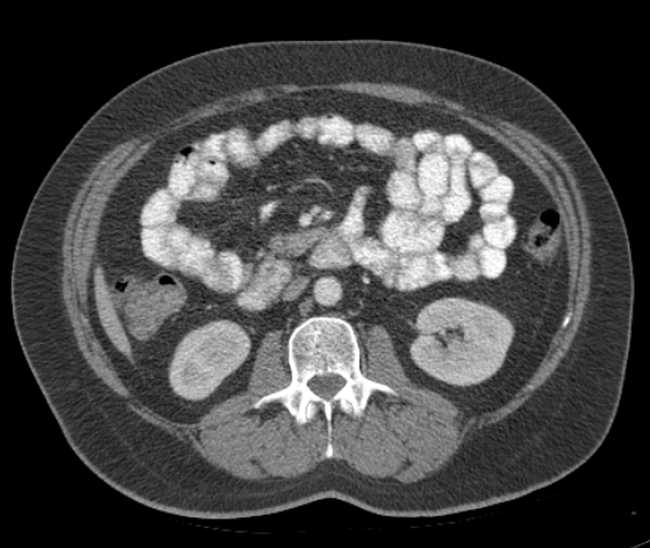 Bleeding duodenal ulcer and adenomyomatosis of gallbladder (Radiopaedia 61834-69861 A 58).jpg
