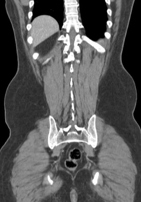 Bleeding duodenal ulcer and adenomyomatosis of gallbladder (Radiopaedia 61834-69861 B 15).jpg