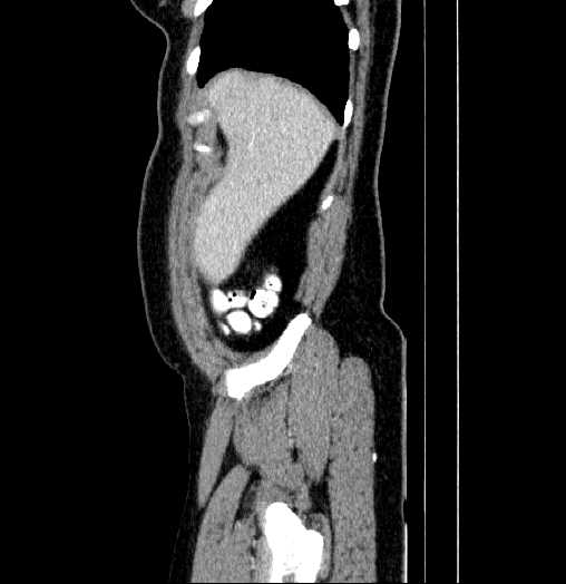 Blind-ending branch of a bifid ureter (Radiopaedia 61159-69048 B 3).jpg
