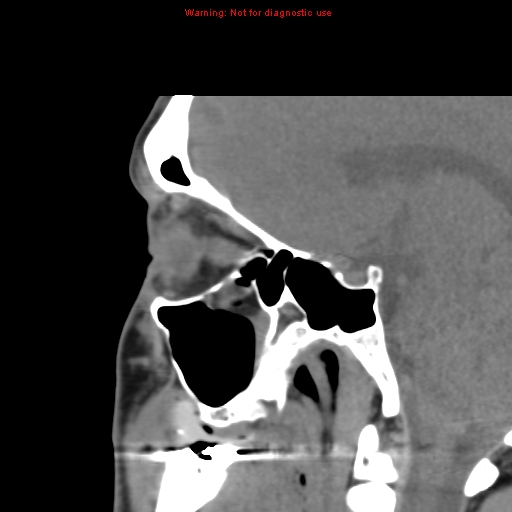 File:Blowout fracture with inferior rectus entrapment (Radiopaedia 12418-12673 C 14).jpg