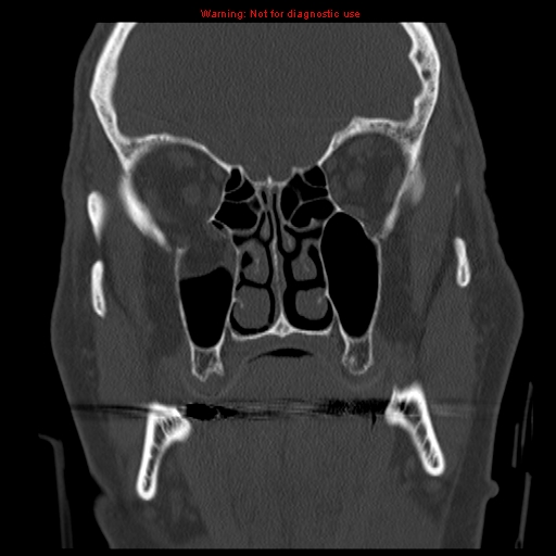 File:Blowout fracture with inferior rectus entrapment (Radiopaedia 12418-12673 Coronal bone window 11).jpg