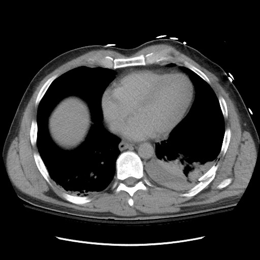 File:Blunt abdominal trauma with solid organ and musculoskelatal injury with active extravasation (Radiopaedia 68364-77895 Axial C+ delayed 9).jpg