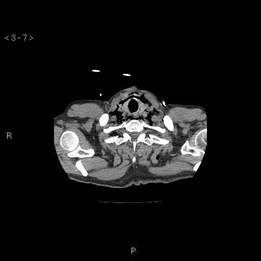 File:Boerhaave syndrome (Radiopaedia 27683-27897 Axial non-contrast 7).jpg